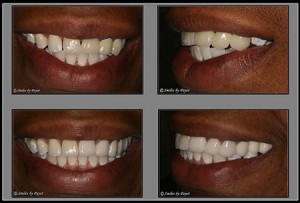 Another example before-after picture for marketing dentistry online.