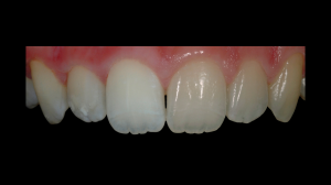 Removing light reflection from teeth with the polar_eyes filter lets color come through